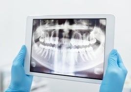 Solución en implantes dentales para pacientes con poco hueso en MAEX Maxilaris