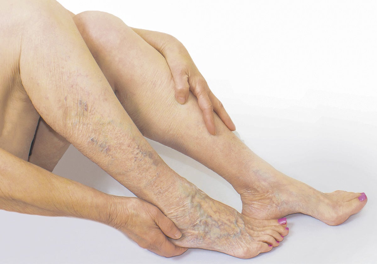 Cuida tus piernas y elimina tus varices