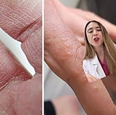 Una dermatóloga vasca explica cómo tratar los granitos en las manos: «Es importante protegerlas del frío y la humedad»