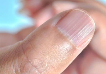 Estrías en las uñas: una señal silenciosa que no se debe ignorar