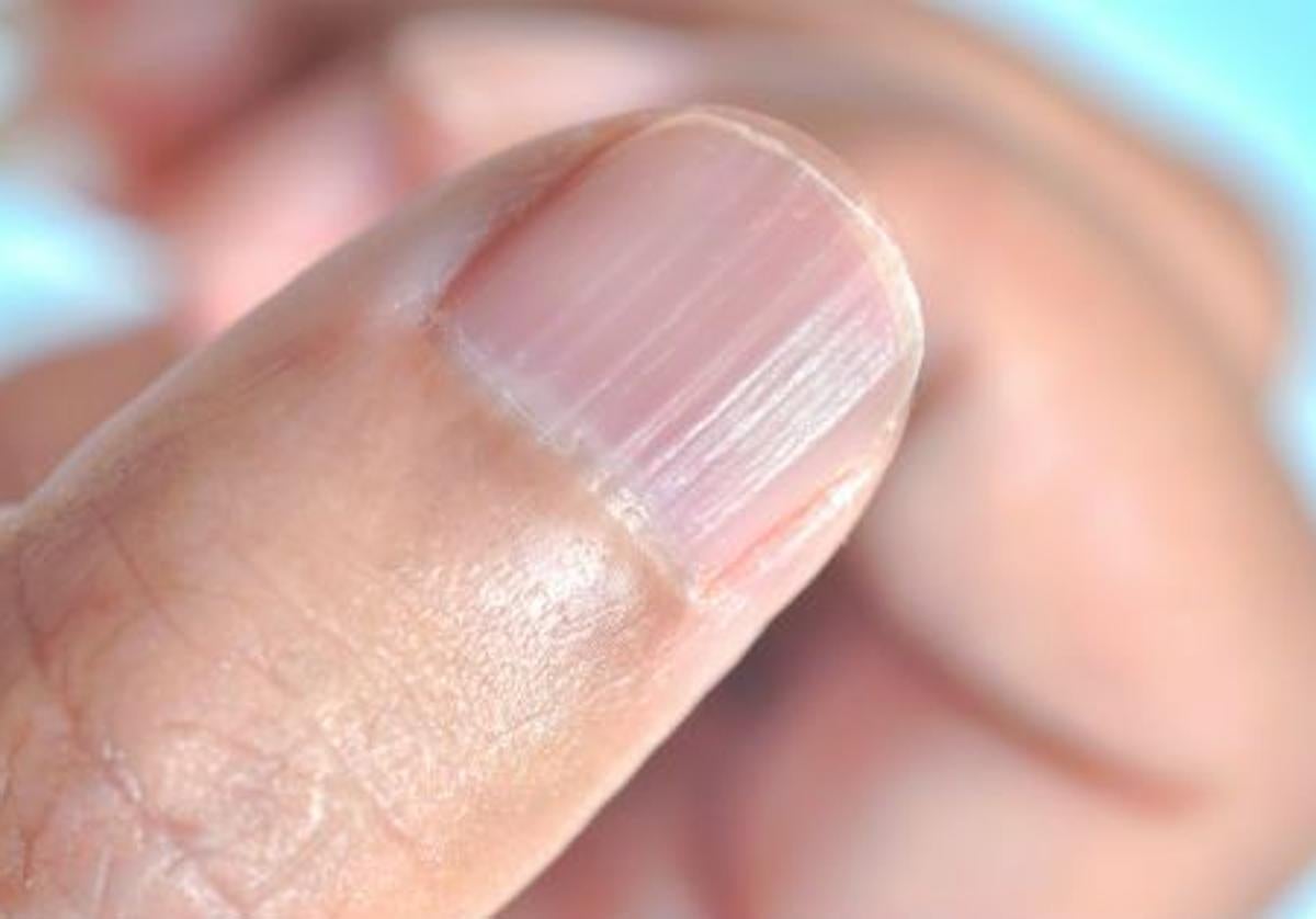 Estrías en las uñas: una señal silenciosa que no se debe ignorar