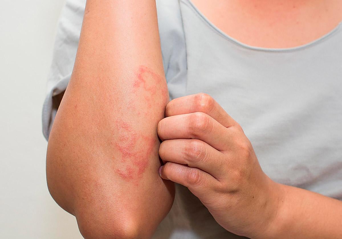 Intestino permeable: la raíz oculta de las enfermedades de la piel