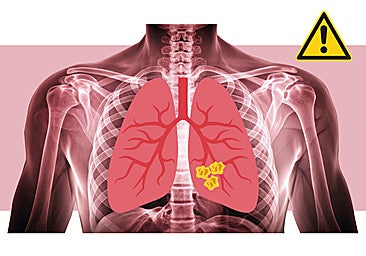 Un equipo del Hospital Donostia reduce a la mitad la mortalidad en los pacientes con cáncer de pulmón