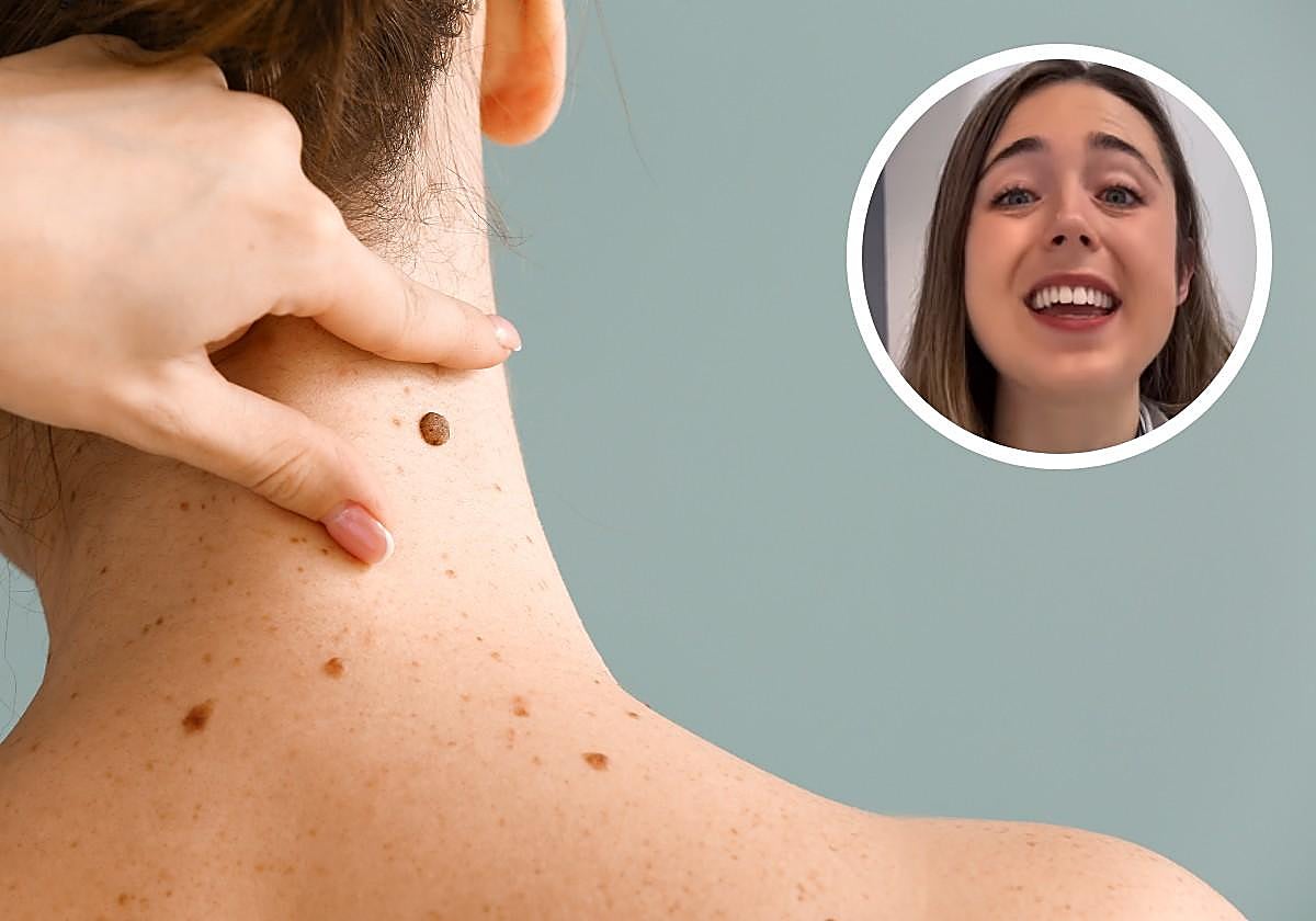 La dermatóloga vasca Leire Barrutia explica cada cuánto hay que revisar los lunares: «No todos tienen el mismo riesgo de desarrollar un melanoma»