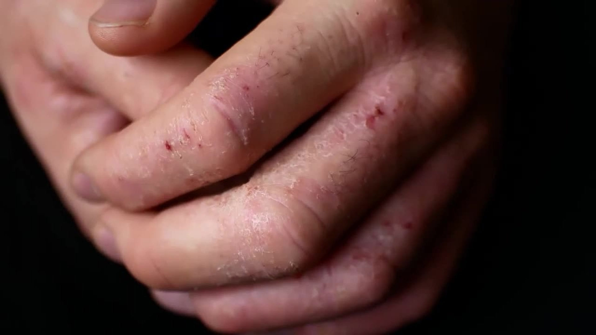 Almirall Marks World Psoriasis Day With Push for More Personalised Dermatology Care