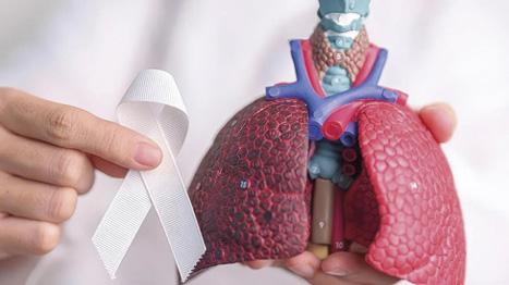 El cribado con TAC de baja dosis y los nuevos tratamientos podrían cambiar el pronóstico del cáncer de pulmón