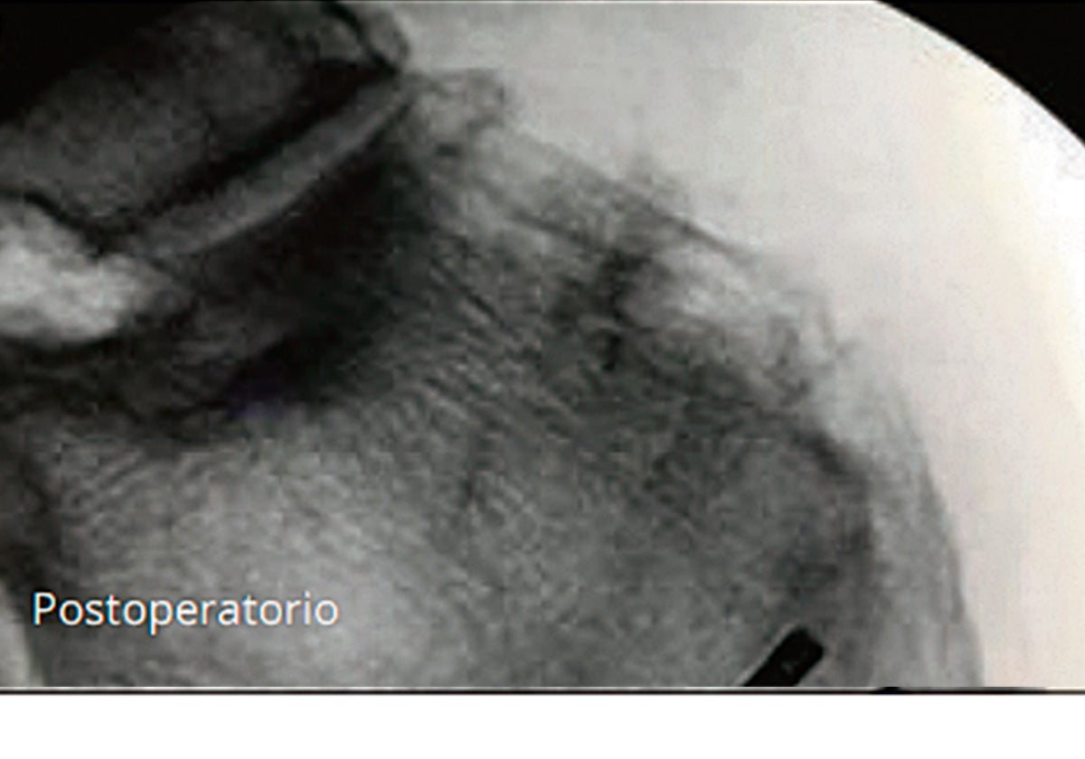 Imagen antes - Última tecnología para corregir deformidades en tu pie
