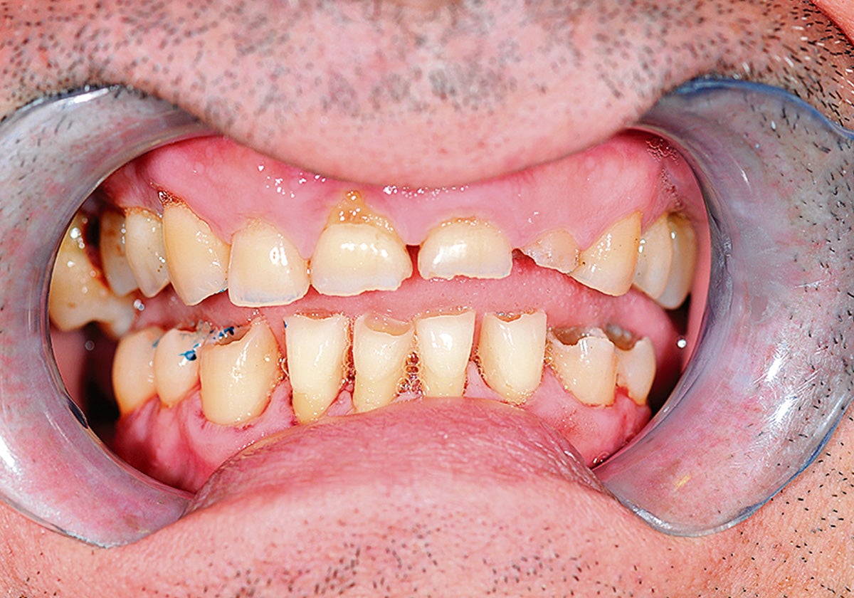 Imagen antes - Tratamiento completo de la boca desde los dientes y las encías hasta el buen aliento