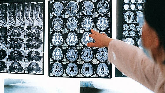 El Alzheimer entra en una etapa diferente con tratamientos que buscan ganar tiempo a la enfermedad