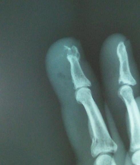 Radiografía que muestra la fractura del dedo de Irujo
