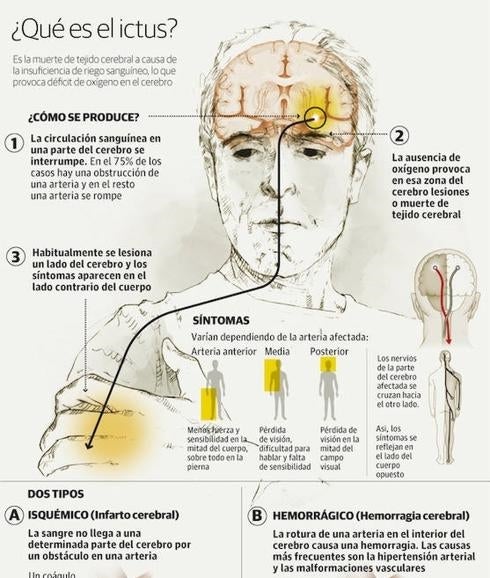GRÁFICO: ¿Qué es el ictus?