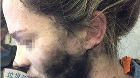 La joven que sufrió  quemaduras al estallar sus auriculares durante un vuelo entre Pekín y Melbourne.