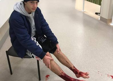 Imagen secundaria 1 - Los misteriosos «piojos de mar» que casi devoran las piernas de un joven en Australia