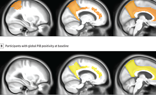 Acúmulo de proteína beta en los cerebros de los pacientes. 