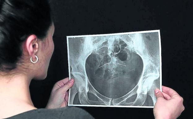 Denuncian que 25.000 pacientes españoles sufren daños a causa de implantes