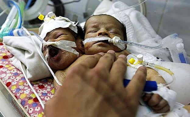 Fallecen los dos bebés siameses que no pudieron ser evacuados en Yemen