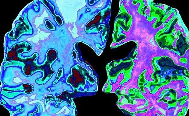 cerebro con Alzhéimer