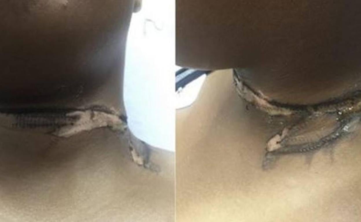 Una joven sufre quemaduras de segundo grado con su cargador de iPhone