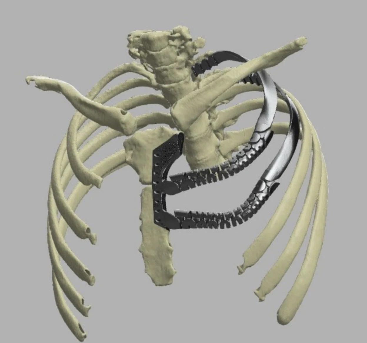 Una de las prótesis dinámicas de titanio impresas en 3D implantadas a un paciente en el HUCA. 