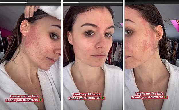 Ángela Rozas Sainz muestra los brotes que le ha dejado en el rostro el coronavirus.