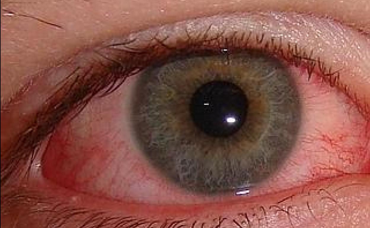 La conjuntivitis puede ser el primer síntoma de coronavirus