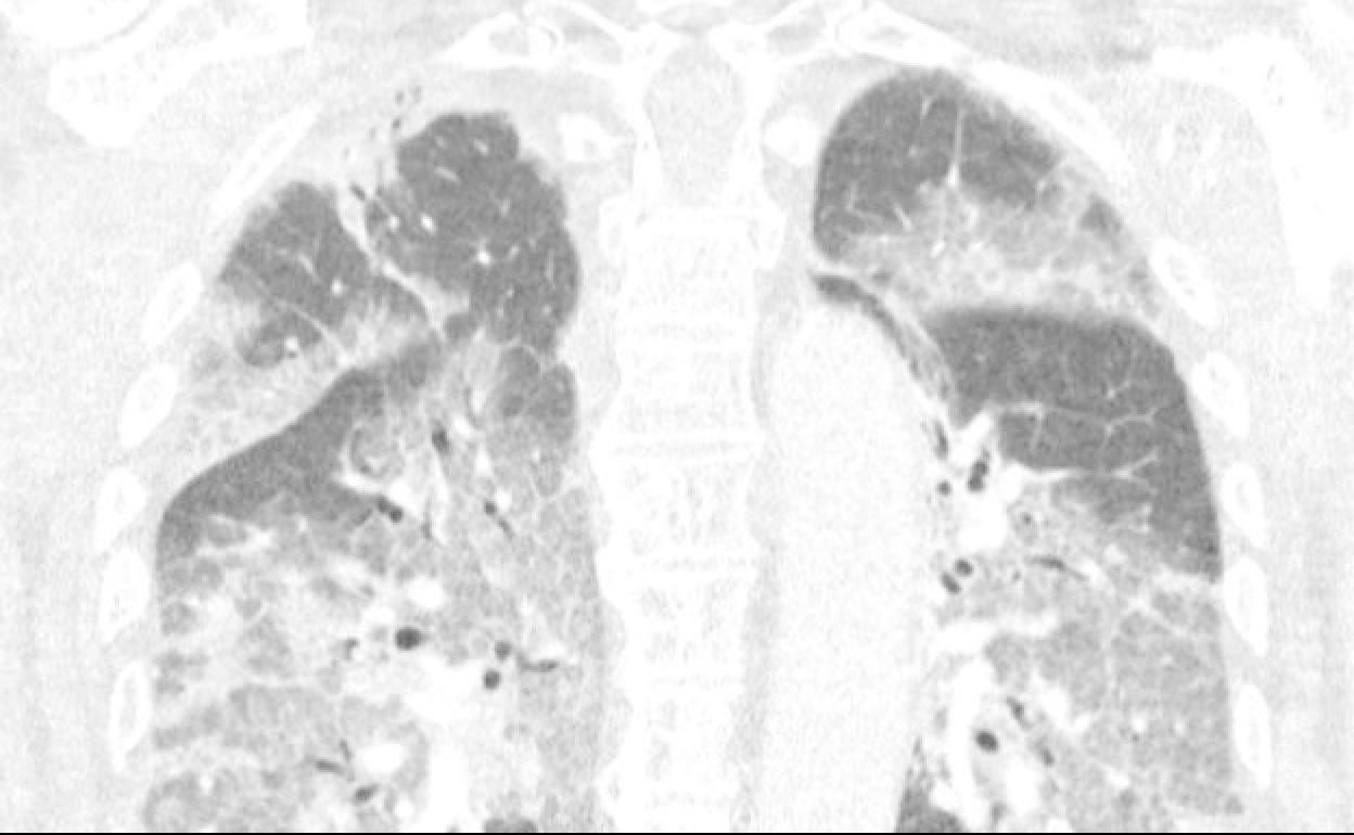 Escáner de los pulmones del paciente ingresado en la UCI en Países Bajos.