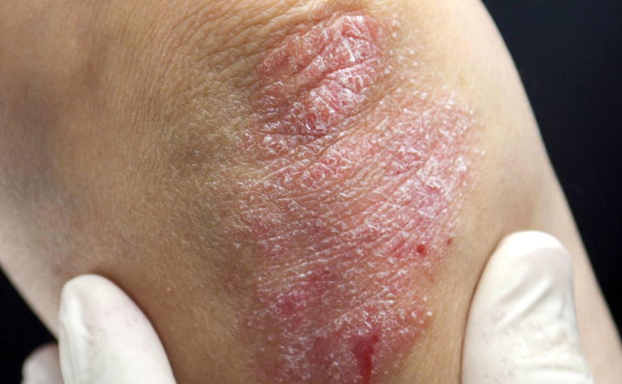 Cerca de un millón de personas sufre psoriasis en España