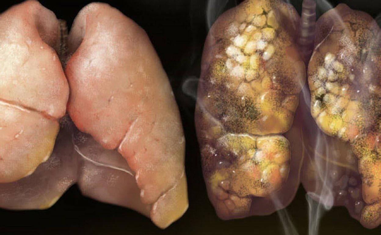 Pulmones sanos y pulmones afectados por el consumo de tabaco
