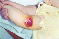 Bebé afectado de ántrax a la piel.