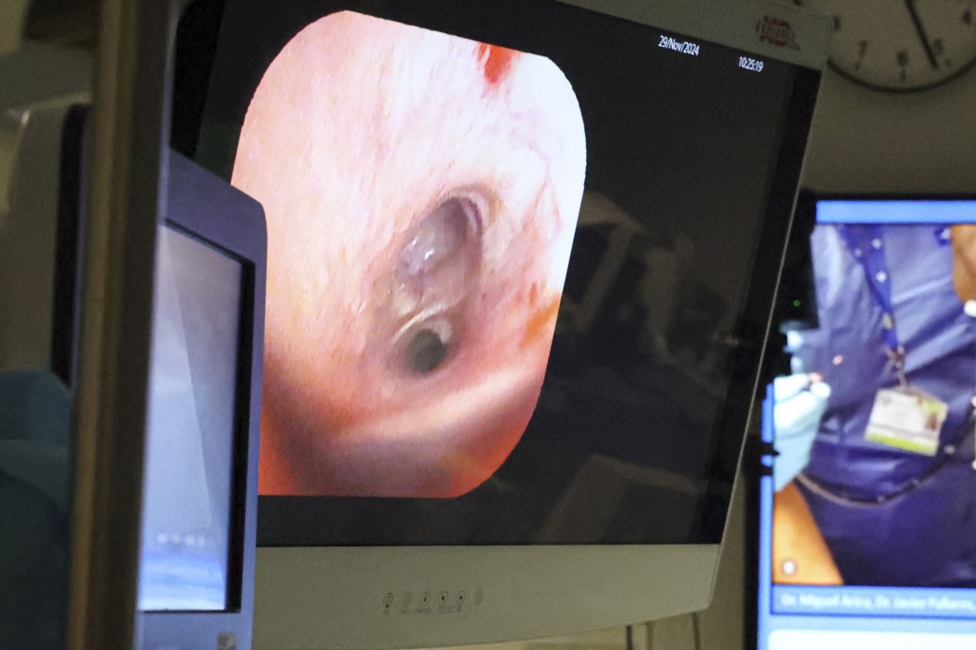 Una nueva técnica de biopsias por congelación de Asturias al mundo: las imágenes de la operación en el HUCA