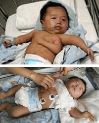 Extirpan con éxito el tercer brazo de un bebé chino de dos meses de edad
