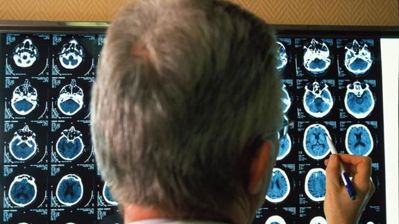 Hallan uno de los mecanismos genéticos implicados en el desarrollo del Alzheimer.