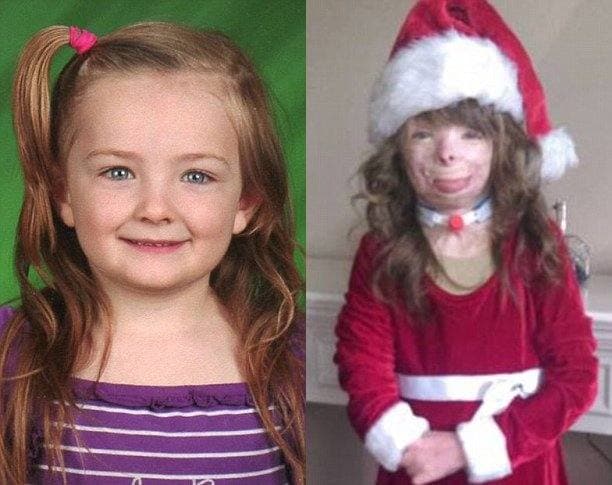 Safyre Terr, antes y después de sufrir las quemaduras provocadas en el incendio en donde perdió a toda su familia