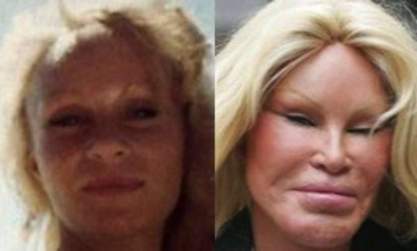 Jocelyn Wildenstein, antes y después de operarse. 