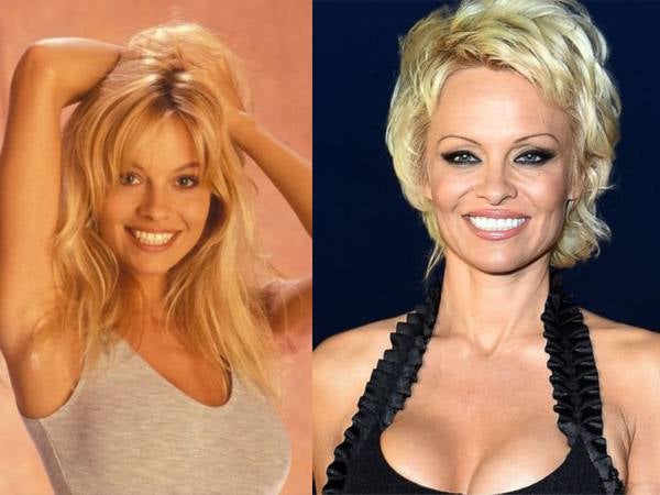 Pamela Anderson, antes y después de operarse. 