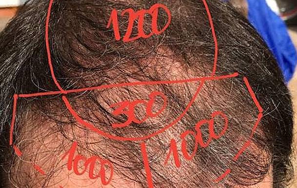 Cálculo de las unidades foliculares a injertar en las diferentes partes de la cabeza.