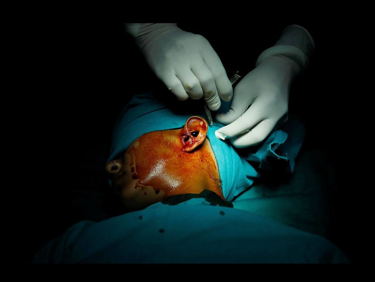 El Lifeline Express ha tratado a más de un millón de personas desde su creación, en 1991. Este tren de siete vagones, decorado con guirnaldas de flores, que atraviesa la India desde hace 27 años, se ha convertido en un verdadero hospital rodante para muchos miles de personas sin recursos. La mayor parte de los médicos son voluntarios de universidades u hospitales cercanos y, por lo general, pasan un mes en un distrito realizando cirugías que van desde cataratas y cáncer hasta hendiduras en el paladar y diversas ortopedias.