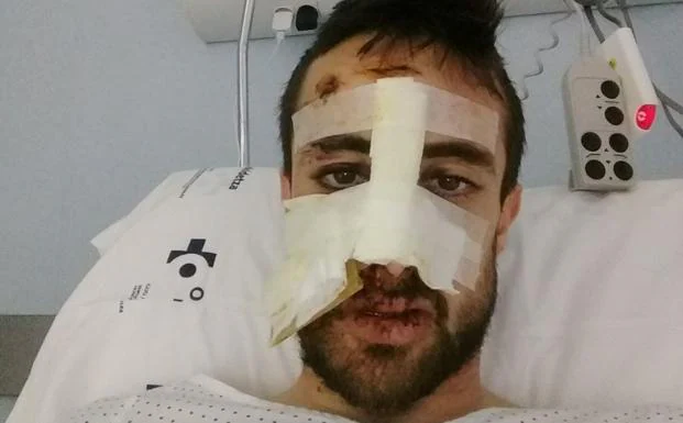Ander Okamika se fracturó la nariz, se hizo cortes en la lengua y labios y perdió algunos dientes en el accidente. 