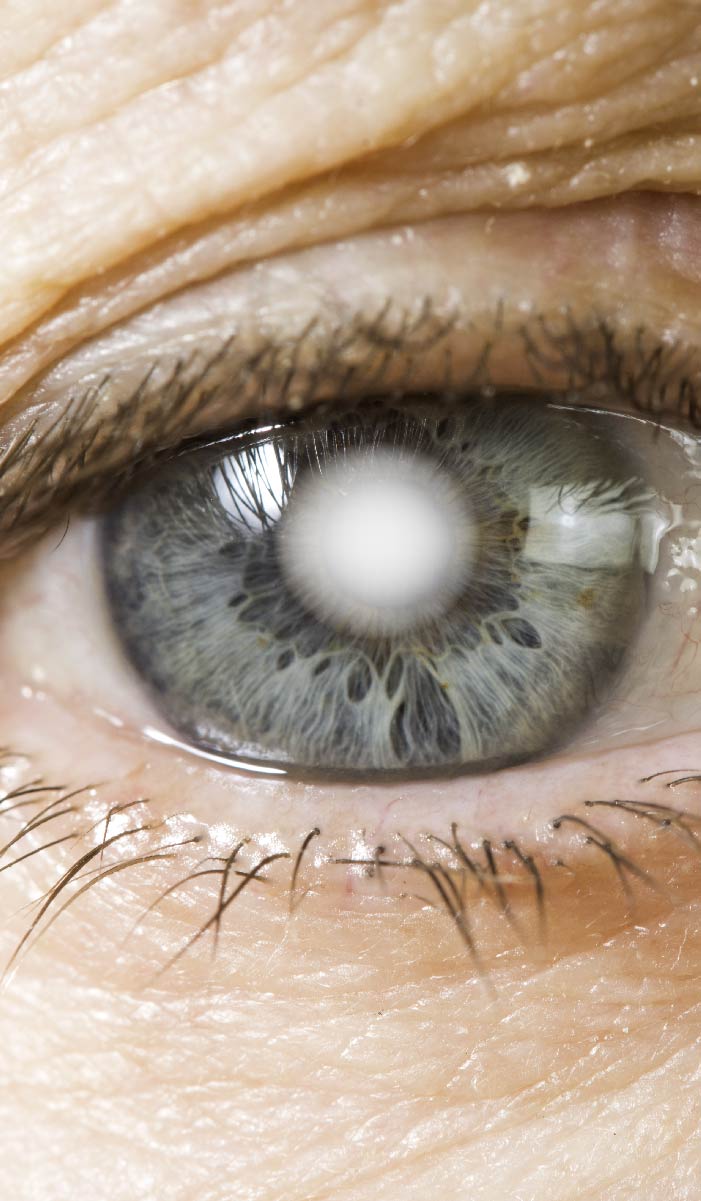 Después de la operación de cataratas ¿ves borroso? Descubre el porqué de este fenómeno ocular