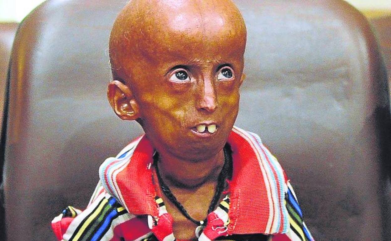 Un enfermo de progeria de 21 años. 