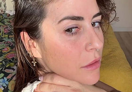 Carmen Estéfano, Trimadre de Princesas, enseña la cicatriz de su cáncer de piel