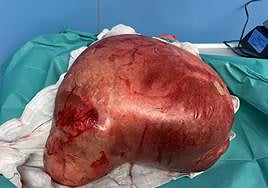 Extirpan un quiste ovárico de 8 kilos a una mujer en San Sebastián