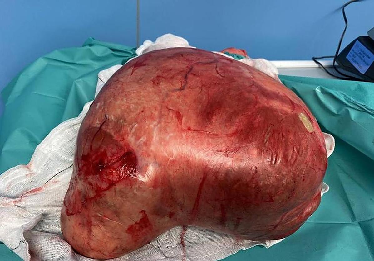 Extirpan un quiste ovárico de 8 kilos a una mujer en San Sebastián