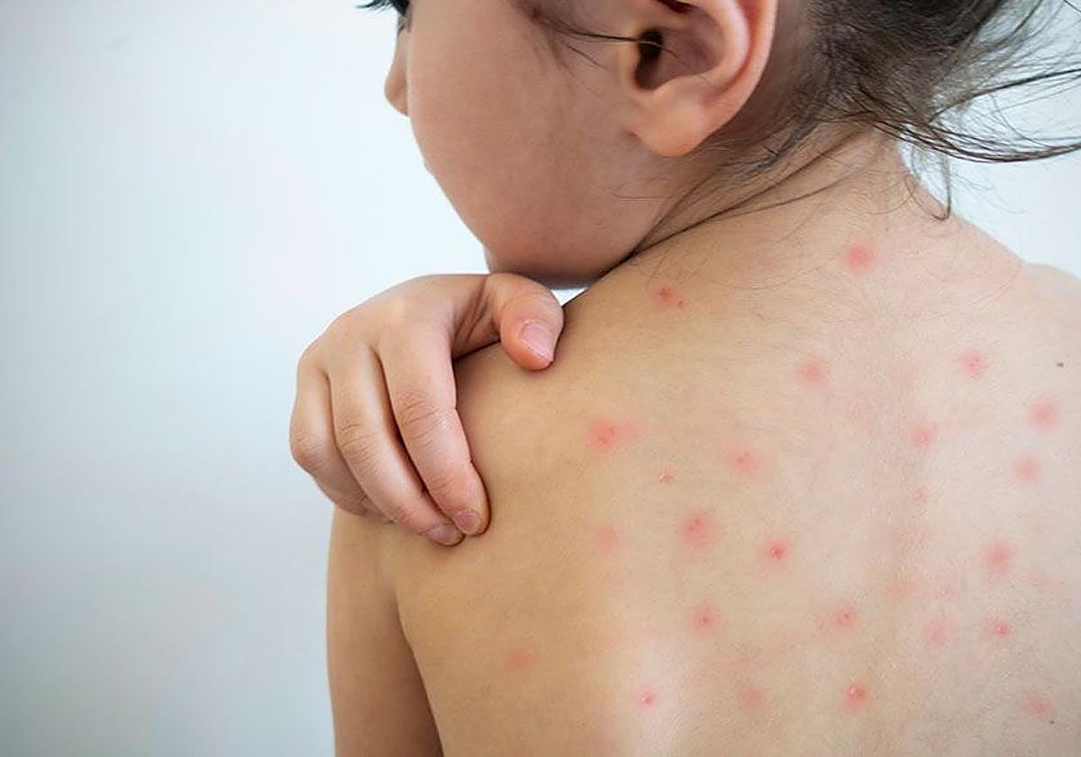 Osakidetza eleva a 38 los casos de sarampión identificados en Euskadi