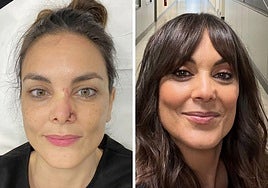 Mónica Carrillo muestra las cicatrices de su cáncer de piel: «Sin filtros ni retoques, así ha sido mi evolución»