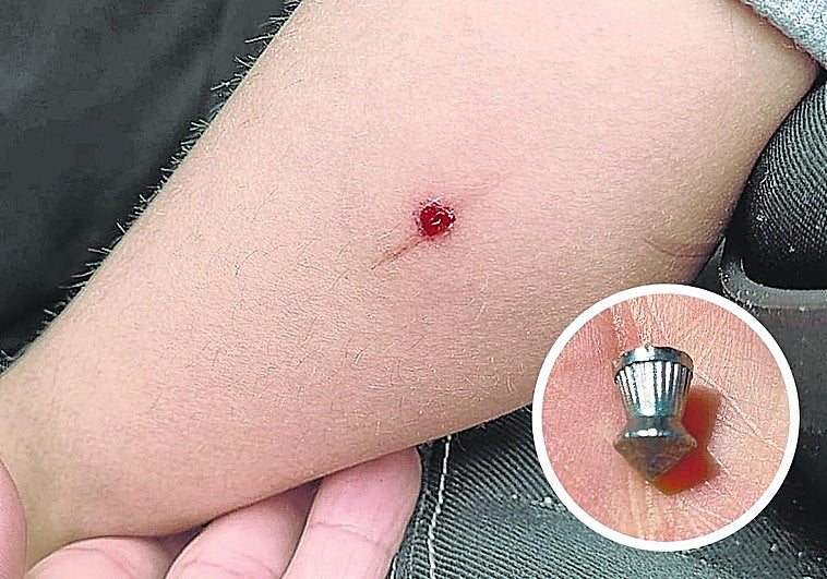 Herido un niño de 6 años por un perdigonazo en un parque de Usansolo