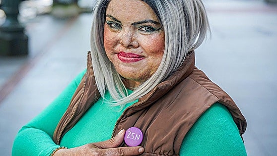«Mi pareja me quemó, pero sigo viva y quiero ayudar a otras»