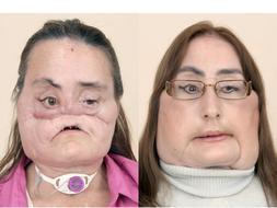 Imagen del rostro de Connie Culp antes y después del trasplante. / Afp
