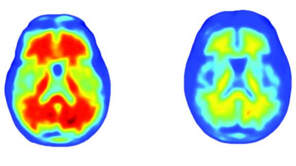 Un fármaco en pruebas frena el deterioro cognitivo del Alzheimer