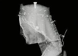 Radiografía de la imagen con los clavos. Servicio de Restauración de la Diputación
